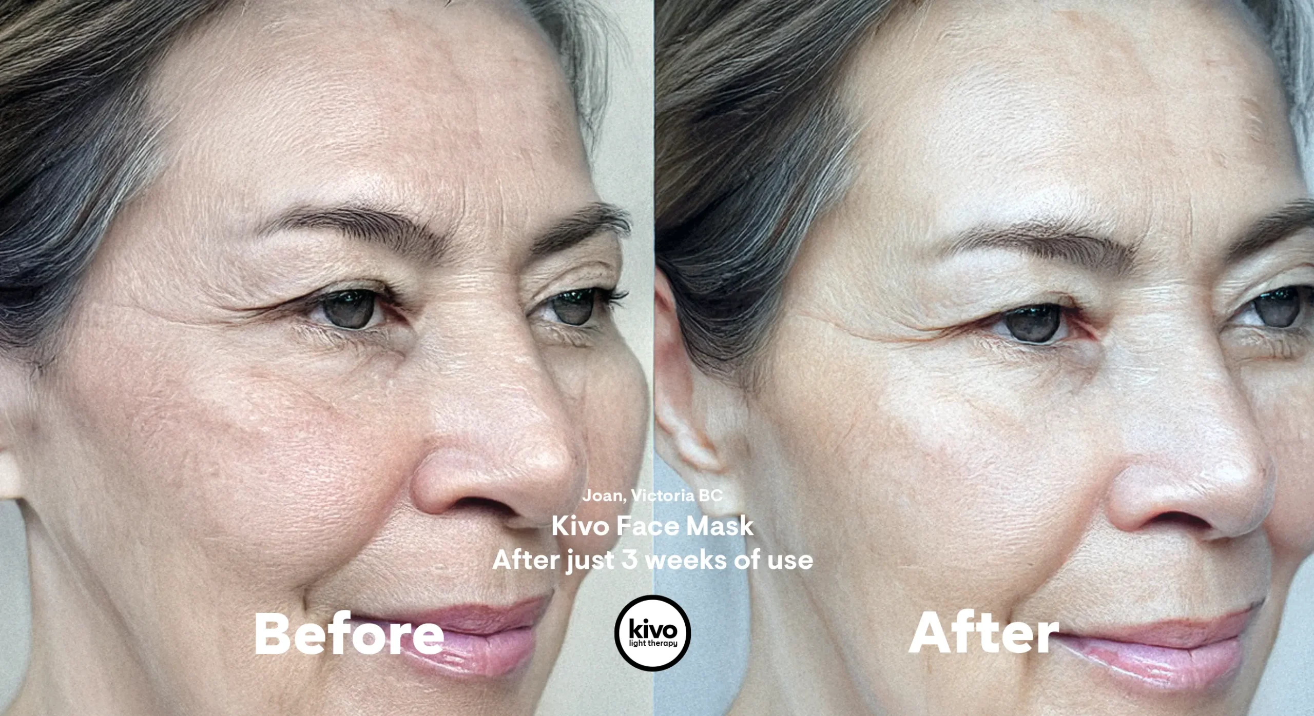 Fine Lines &amp; Wrinkles